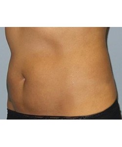 CoolSculpting Before & After Photo