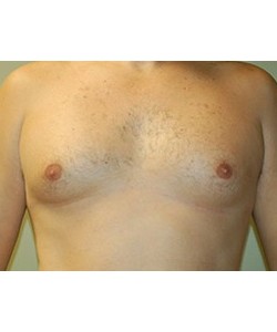 CoolSculpting Before & After Photo