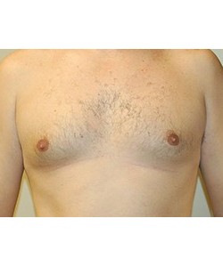 CoolSculpting Before & After Photo