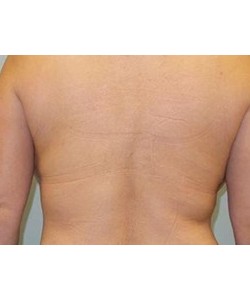 CoolSculpting Before & After Photo