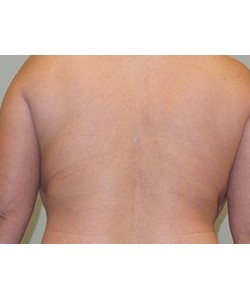 CoolSculpting Before & After Photo