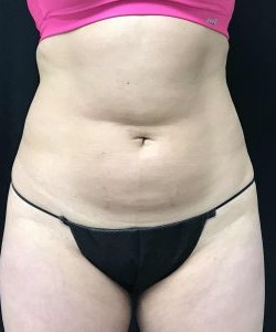 CoolSculpting Before & After Photo