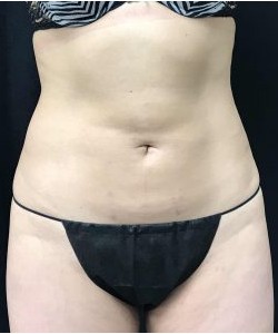 CoolSculpting Before & After Photo