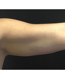 CoolSculpting Before & After Photo