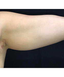 CoolSculpting Before & After Photo