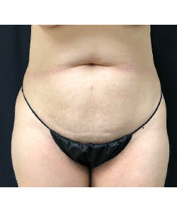 CoolSculpting Before & After Photo