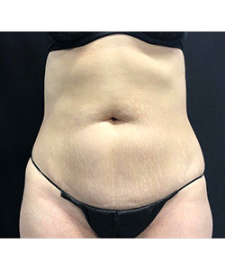 CoolSculpting Before & After Photo