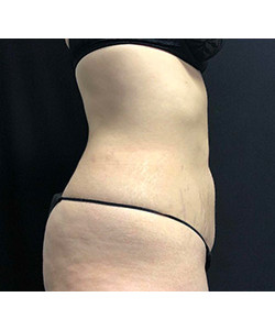 CoolSculpting Before & After Photo