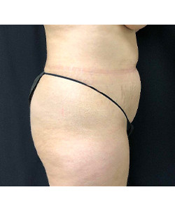 CoolSculpting Before & After Photo