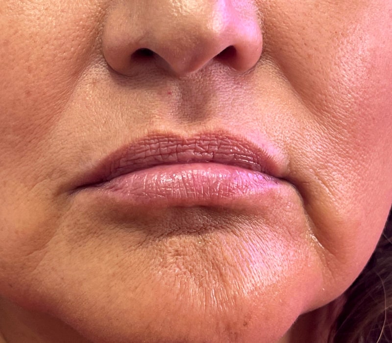 Facial Fillers Before & After Photo