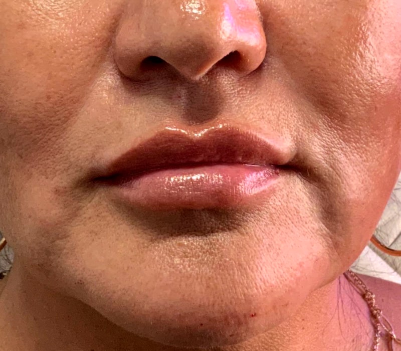 Facial Fillers Before & After Photo