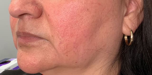 Facial Fillers Before & After Photo