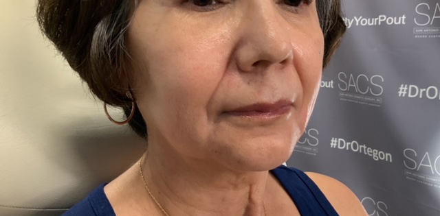 Facial Fillers Before & After Photo