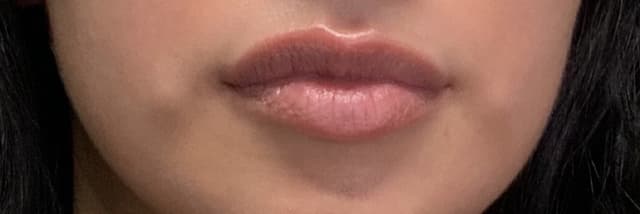 Lip Fillers Before & After Photo