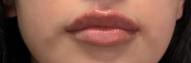 Lip Fillers Before & After Photo