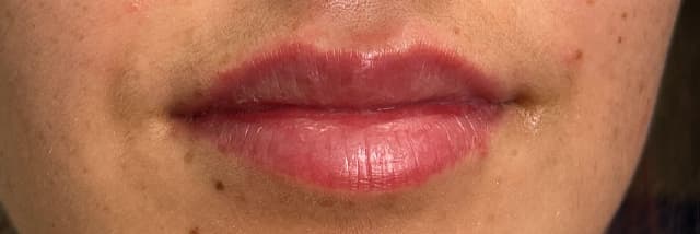 Lip Fillers Before & After Photo