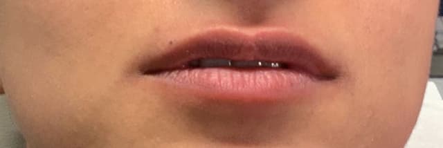 Lip Fillers Before & After Photo