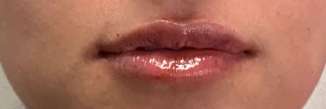 Lip Fillers Before & After Photo