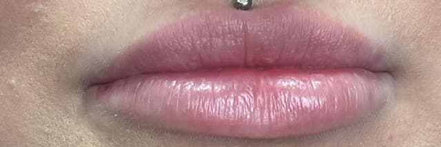 Lip Fillers Before & After Photo