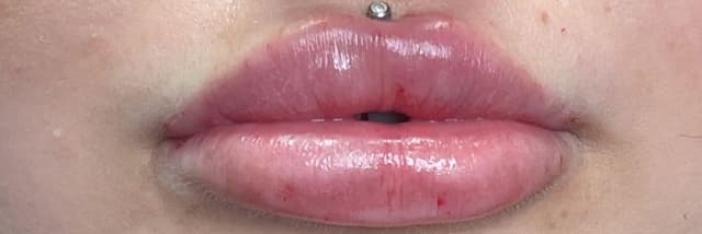 Lip Fillers Before & After Photo