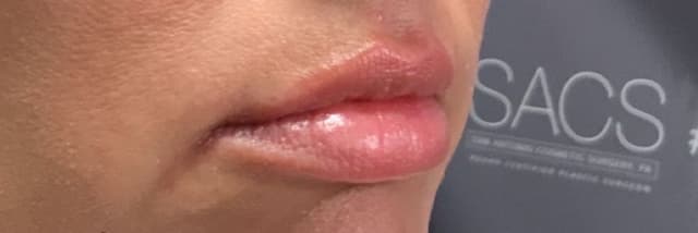 Lip Fillers Before & After Photo