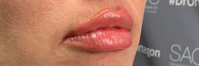 Lip Fillers Before & After Photo