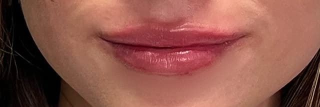 Lip Fillers Before & After Photo