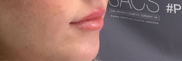 Lip Fillers Before & After Photo