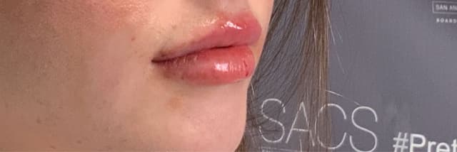 Lip Fillers Before & After Photo