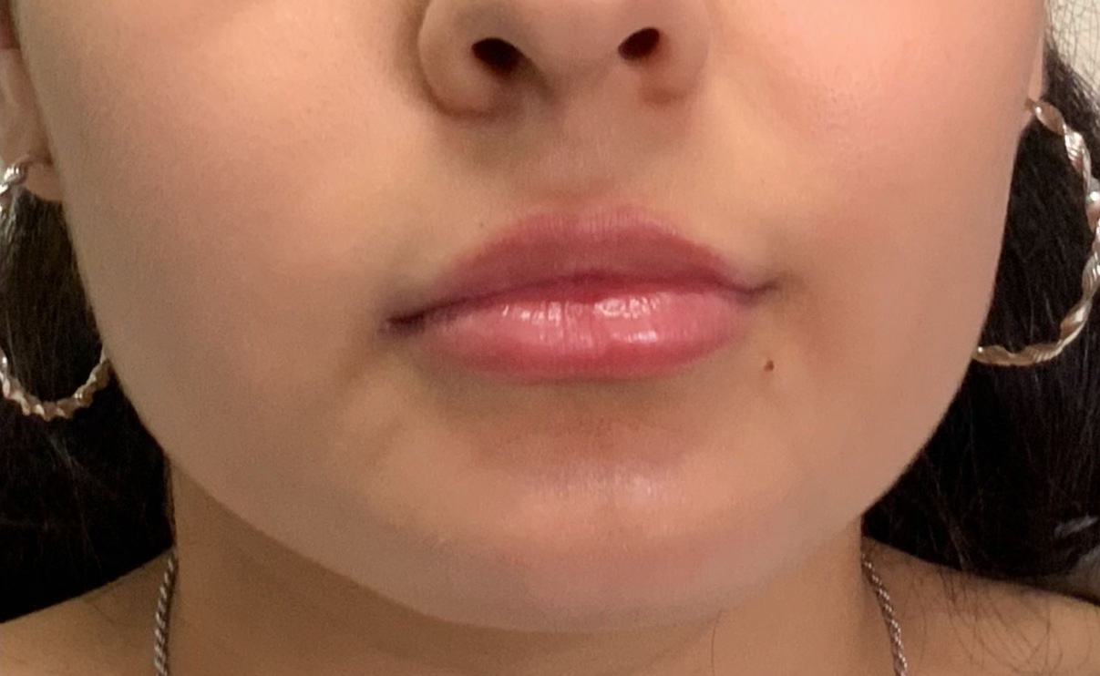 Lip Fillers Before & After Photo