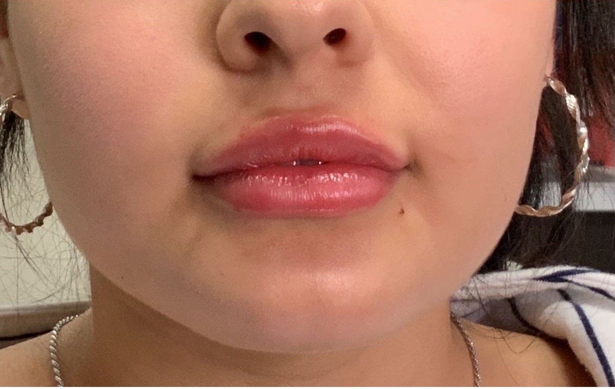 Lip Fillers Before & After Photo