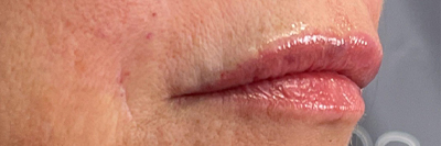 Lip Fillers Before & After Photo