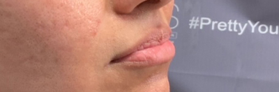 Lip Fillers Before & After Photo