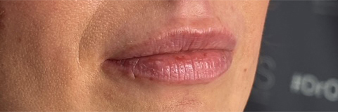 Lip Fillers Before & After Photo