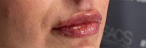 Lip Fillers Before & After Photo