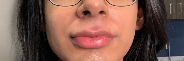 Lip Fillers Before & After Photo