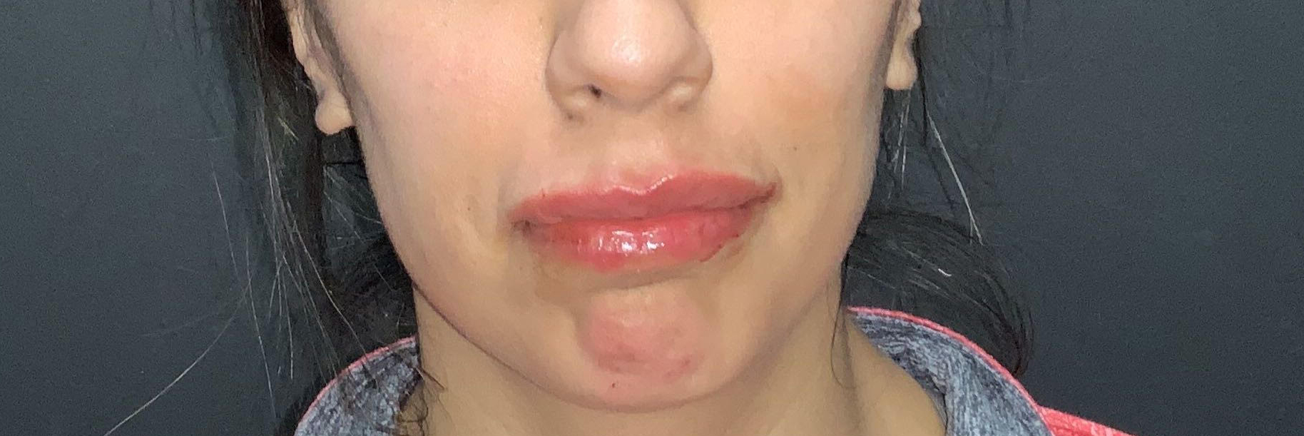 Lip Fillers Before & After Photo