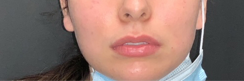 Lip Fillers Before & After Photo