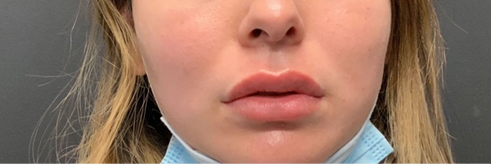 Lip Fillers Before & After Photo