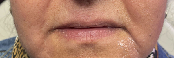 Lip fillers Before & After Image