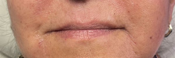 Lip fillers Before & After Image