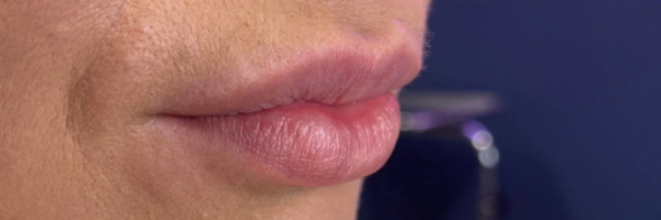 Lip fillers Before & After Image