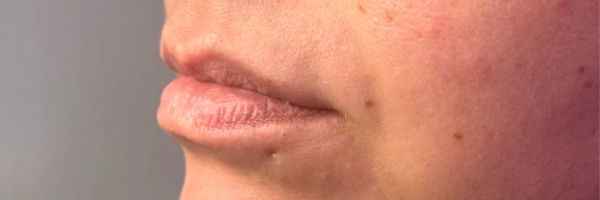 Lip fillers Before & After Image