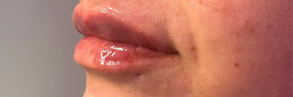 Lip fillers Before & After Image
