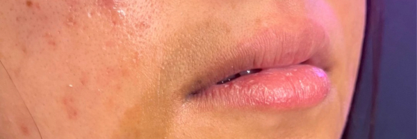 Lip fillers Before & After Image