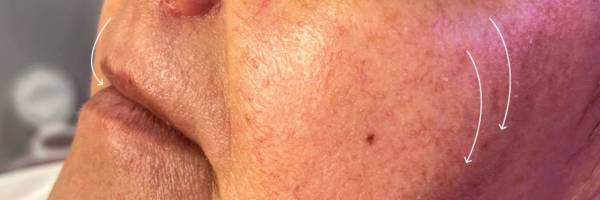 Lip fillers Before & After Image