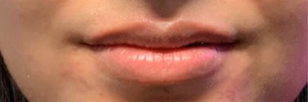 Lip fillers Before & After Image