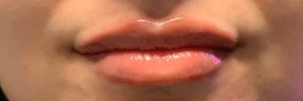 Lip fillers Before & After Image