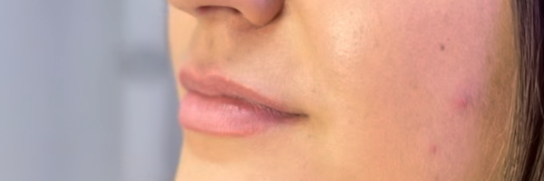 Lip fillers Before & After Image