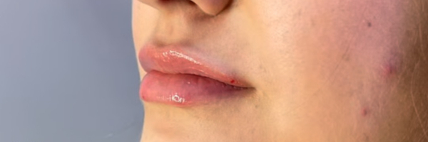 Lip fillers Before & After Image